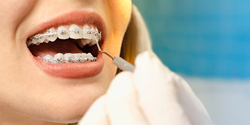 Ortodoncia metálica autoligable